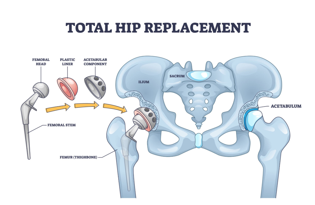Hip Replacement Surgery